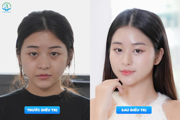 Trẻ hóa da đa tầng giải pháp chăm sóc da khỏe, đẹp, an toàn tại Phòng khám da liễu Hà Nội z5975496491970 f0bf8cf6e356e4cff632daa2af89d036